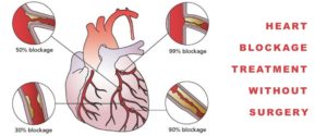 blockages artery blockage